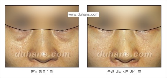 [두한성형외과 경쟁력 주름성형] - [미세지방이식을 이용한 주름교정 안내 - 눈밑주름, 입가주름, 팔자주름 2.] 관련 이미지 17