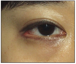 Candidates for Double Eyelid Revision Surgery: Unattractive Double Eyelids, Beautiful Double Eyelids image 26