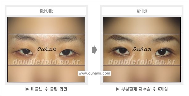 ​[두한성형외과 쌍꺼풀 재수술] - [푸는 수술을 하고 내원했을 경우의 문제] 관련 이미지 6