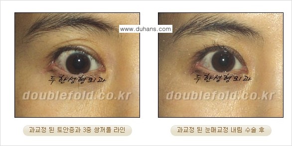 [두한성형외과 쌍꺼풀 재수술] - [눈매교정이 과한 경우의 문제] 관련 이미지 1