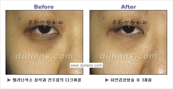 [두한성형외과의 상큼하고 환한 젊은 눈매완성] - [하안검 성형술 ②] 관련 이미지 10