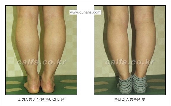 ⁠⁠[두한성형외과 경쟁력 멀티종아리성형] - [지방흡입이 필요한 종아리 비만 안내] 관련 이미지 6