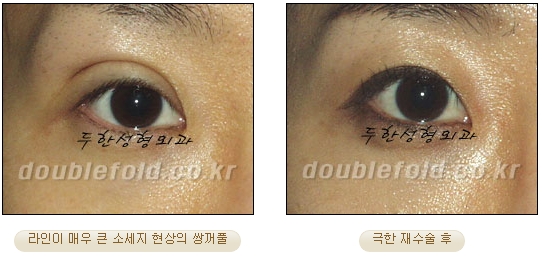 [DoubleFold Plastic Surgery Eye Surgery] - [Revision Surgery for Thick Double Eyelids] image 46