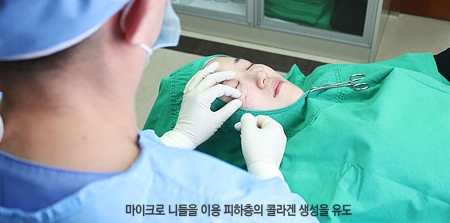 [두한성형외과 다크서클] - [콜펫지방이식] 관련 이미지 11