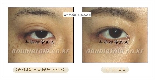 [두한성형외과 경쟁력 쌍꺼풀 재수술] - [극한의 상태에서 쌍꺼풀 재수술 안내 ②] 관련 이미지 9