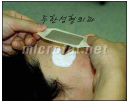[Duhan Plastic Surgery Wrinkle Improvement] - [Wrinkle Filler Procedure] image 5