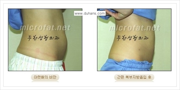 [두한성형외과 경쟁력 바디성형] - [하복부, 팔뚝, 허리선, 허벅지, 엉덩이 간편지방흡입술] 관련 이미지 13