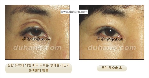 [두한성형외과 성형 FOCUS] - [정상적인 눈매로의 복원 극한재수술 경우 ②] 관련 이미지 11