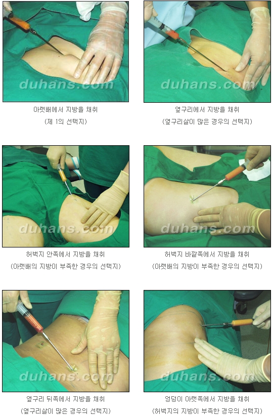 [두한성형외과 얼굴자가지방이식] - [지방이식 과정] 관련 이미지 3