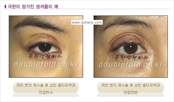 [두한성형외과 무한 경쟁력 "극한 눈(쌍꺼풀) 재수술"] - [망가진 라인을 교정하는 극한 눈(쌍꺼풀) 재수술] 관련 이미지 3
