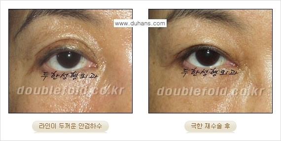 [두한성형외과 경쟁력 눈성형] - [극한의 상태에서 쌍꺼풀재수술(눈재수술) 안내] 관련 이미지 7