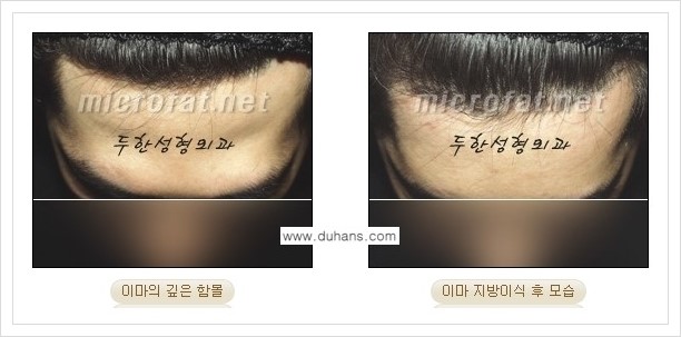 [두한성형외과 경쟁력 미세지방이식] - [부드럽고 아름다운 얼굴 윤곽선 이마(전두부) 미세지방이식] 관련 이미지 13