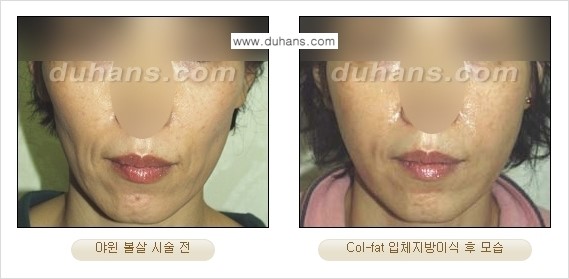 [두한성형외과 경쟁력 미세지방이식]-[Col-fat 입체지방이식 사례 안내] 관련 이미지 13