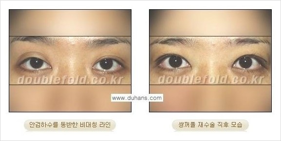 [두한성형외과 경쟁력 눈성형] - [두껍고 수술한 표시가 나는 어색한 쌍꺼풀 라인의 교정 방법] 관련 이미지 18