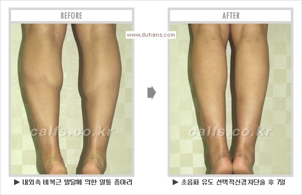 [두한성형외과 경쟁력 멀티종아리성형] - [알통종아리 해결 - 비절개 초음파 선택적 신경차단술] 관련 이미지 17