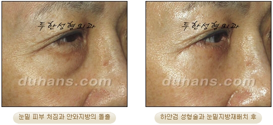 [Duhan Plastic Surgery Ophthalmic Plastic Surgery] - [Lower Blepharoplasty] image 35