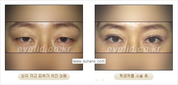 [두한성형외과 성형 FOCUS] - [퀵쌍꺼풀 수술 ④] 관련 이미지 4