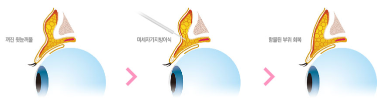 두한성형외과의 다크서클 + 눈위지방이식 콤비프로그램 관련 이미지 5
