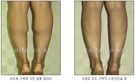 [두한성형외과 종아리퇴축술] - [NO절개! 초음파유도신경차단술] 관련 이미지 34