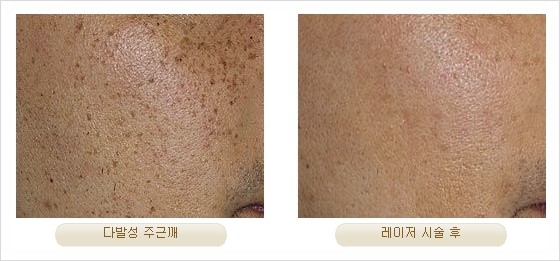 [두한성형외과 경쟁력 안전성형] - [최첨단 장비를 이용한 흉터, 점, 주근깨, 잡티, 문신제거 레이저 시술] 관련 이미지 25