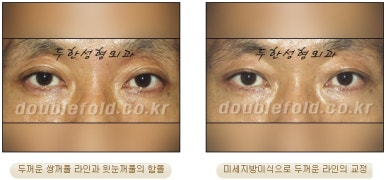 [두한성형외과 쌍커풀수술] - [쌍꺼풀지방이식] 관련 이미지 14
