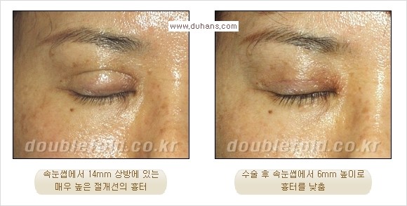 ⁠⁠[두한성형외과 경쟁력 쌍꺼풀 재수술] - [재수술 대상과 재수술의 문제점] 관련 이미지 15