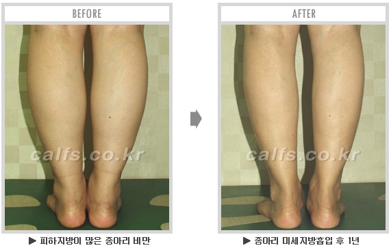 [종아리성형 두한성형외과] - [종아리수술에 대한 자주하는 질문과 답변 모음] 관련 이미지 80