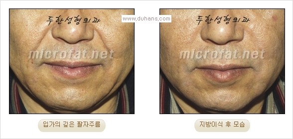 [두한성형외과 경쟁력 주름성형] - [입가주름과 코옆 팔자주름제거 지방이식 시술의 효과] 관련 이미지 10