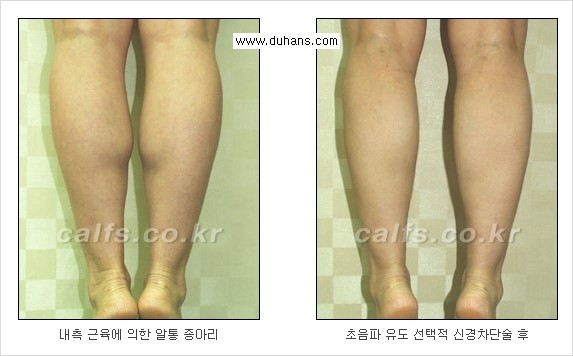 [두한성형외과 경쟁력 멀티종아리성형] - [종아리 근육 퇴축술에 관한 질문과 답변] 관련 이미지 22