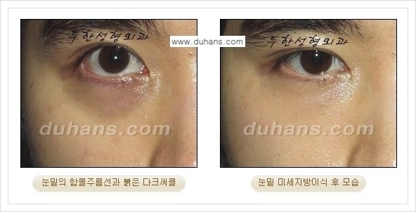 [두한성형외과 경쟁력 눈밑성형] - [다크써클과 눈밑주름을 위한 미세지방이식 안내] 관련 이미지 6