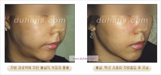 [두한성형외과 경쟁력 지방흡입] - [볼살, 턱선의 간편 지방흡입] 관련 이미지 17