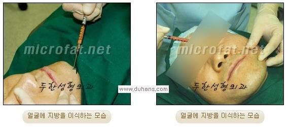 ​[두한성형외과 경쟁력 미세지방이식] - [타 병원에서 지방이식 후 발생한 굴곡현상 교정 방법 - 마이크로 지방이식] 관련 이미지 4