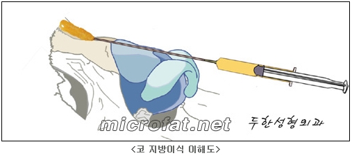 [두한성형외과 지방이식] - [지방이식을 이용한 코성형] 관련 이미지 2