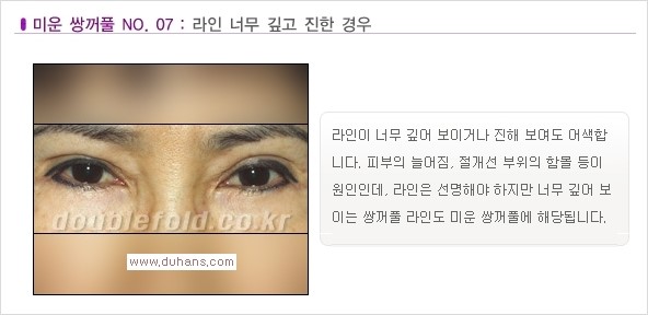 [두한성형외과 경쟁력 눈성형] - [나에게 맞는 맞춤 쌍꺼풀 찾기] 관련 이미지 7