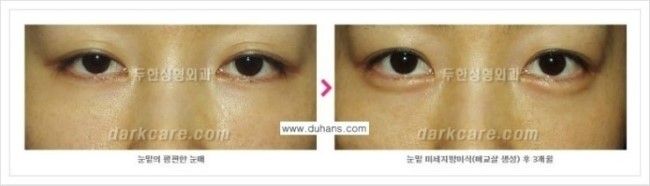[두한성형외과 경쟁력 눈밑성형] - [눈밑애교살 시술을 위한 미세지방이식] 관련 이미지 22