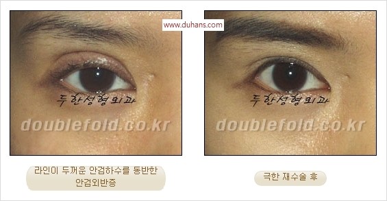 [두한성형외과 경쟁력 쌍꺼풀 재수술] - [두꺼운 라인을 교정하는 극한 재수술(Extreme Rroperation)] 관련 이미지 20