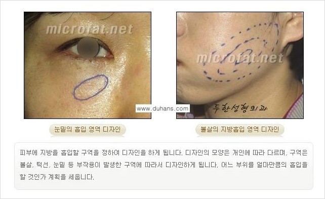 [두한성형외과 경쟁력 미세지방이식] - [타병원의 지방이식 부작용 교정을 위한 마이크로 흡입술 안내] 관련 이미지 2