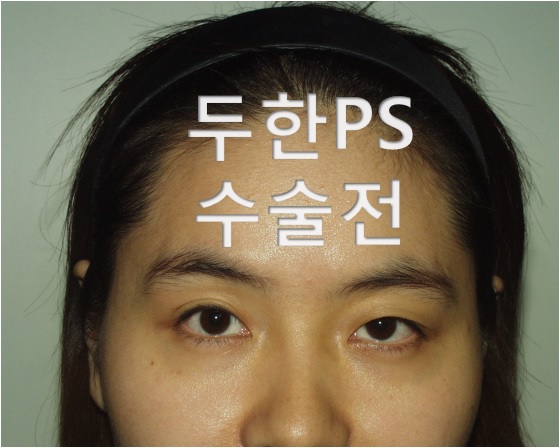 [두한ps]-#눈위,#눈밑,#이마,#관자(#측두부)#지방이식으로 얼굴 볼륨감 살리기 , #꺼진눈꺼풀,#눈꺼풀지방이식 관련 이미지 1