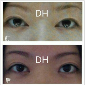 [Duhan Plastic Surgery Double Eyelid Surgery] - [Types of Double Eyelid Surgery] image 40