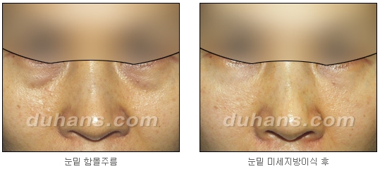 [두한성형외과 주름교정] - [주름개선 지방이식] 관련 이미지 20