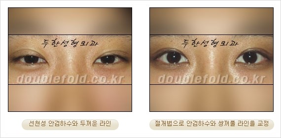 [두한성형외과 경쟁력 눈성형] - [안검하수(졸리운 눈매) 교정 방법 안내] 관련 이미지 23
