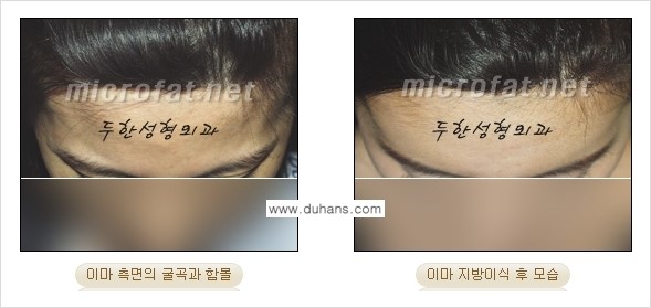 [두한성형외과의 경쟁력 있는 지방이식] - [이마 미세지방이식 2.] 관련 이미지 10