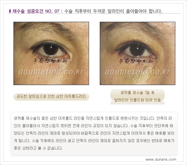 [두한성형외과 경쟁력 쌍꺼풀 재수술, 극한 눈재수술] - [망가진 쌍꺼풀 재수술의 성공요건 안내] 관련 이미지 8