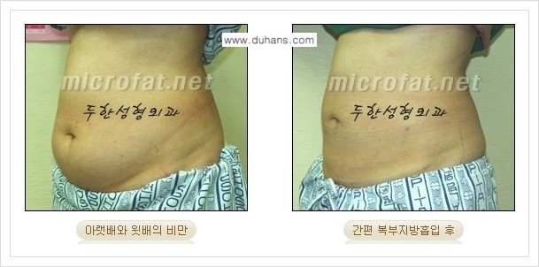 [두한성형외과 경쟁력 바디성형] - [하복부, 팔뚝, 허리선, 허벅지, 엉덩이 간편지방흡입술] 관련 이미지 20