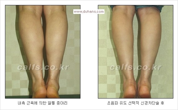 [두한성형외과 Dr. 컬럼] - [종아리 근육퇴축술로 가장 선호하는 비절개 초음파 유도 선택적 신경차단술] 관련 이미지 3