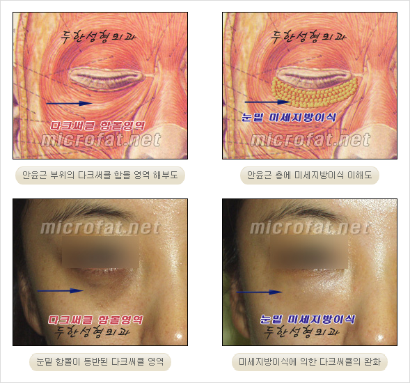 [두한성형외과 경쟁력 눈밑성형 리더] - [윗눈꺼풀 지방제거, 눈밑지방제거, 눈밑지방재배치, 눈밑지방이식 안내] 관련 이미지 20