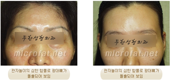 [두한성형외과 얼굴지방이식] - [측두부, 관자놀이] 관련 이미지 2