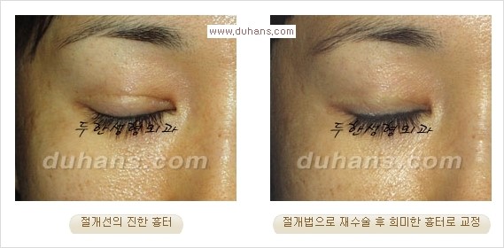[두한성형외과 경쟁력 쌍꺼풀 재수술, 극한 눈재수술] - [절개법 수술후 쌍꺼풀 흉터선이 진한 경우의 교정 안내] 관련 이미지 4