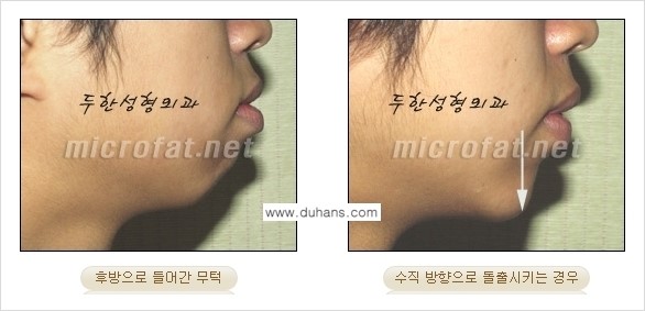 [두한성형외과 경쟁력 미세지방이식] - [부드럽고 아름다운 얼굴윤곽선 턱(하악부) 미세지방이식 안내] 관련 이미지 5
