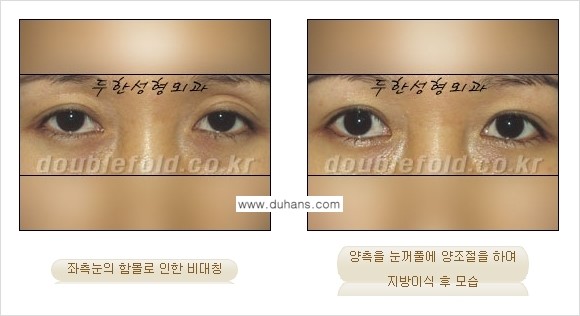 [두한성형외과 NO.1 눈성형] - [함몰된(꺼진) 눈꺼풀에서 쌍꺼풀 라인 교정 3.] 관련 이미지 3